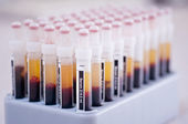 Exame de sangue para detectar 50 tipos de c&acirc;ncer mostra resultados animadores