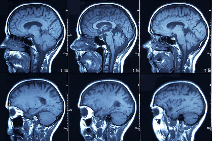 Combinação de Tafinlar + Mekinist recebe aprovação da FDA para glioma pediátrico