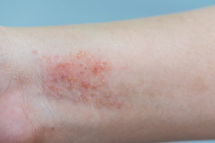 Dermatite atópica infantil foi associada a maiores riscos de dificuldades de aprendizagem e memória