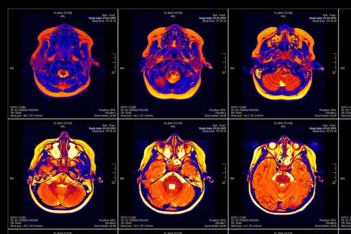 Estimula&ccedil;&atilde;o cerebral profunda pode reduzir o impacto emocional das mem&oacute;rias