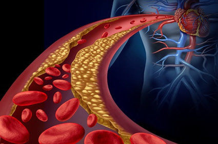 Estudo confirmou a ligação entre isquemia miocárdica induzida por estresse mental e eventos cardiovasculares em pessoas com doença coronariana estável