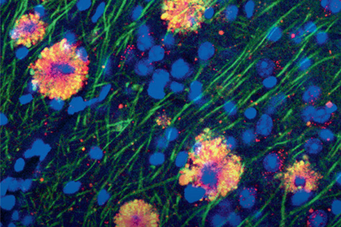 Estudo indica nova hipótese sobre a causa da doença de Alzheimer, que precederia o acúmulo de beta-amiloide