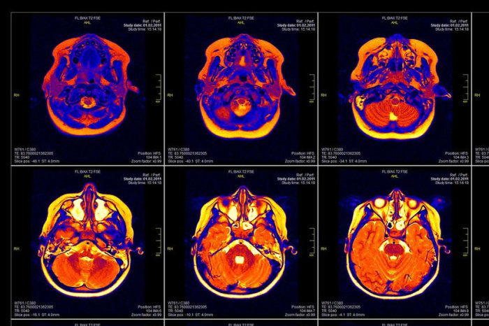 Estudo sobre fumantes cujo v&iacute;cio desapareceu ap&oacute;s um AVC aponta para um circuito cerebral que pode alimentar o v&iacute;cio 