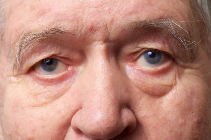 FDA concede aprova&ccedil;&atilde;o acelerada para um novo medicamento destinado ao tratamento do Alzheimer, chamado Aduhelm (aducanumabe)