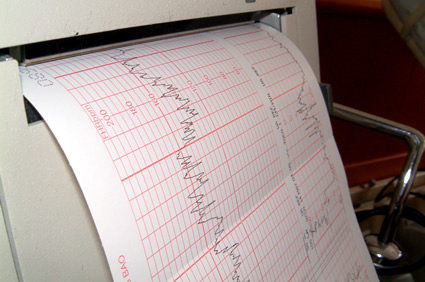 Fibrilação atrial pós-operatória pode sinalizar risco aumentado de hospitalizações por insuficiência cardíaca