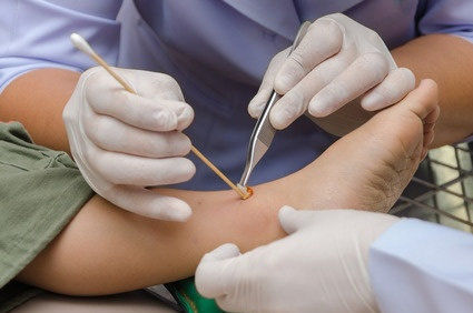 Gel t&oacute;pico de esmolol ajudou a curar &uacute;lceras de p&eacute; diab&eacute;tico