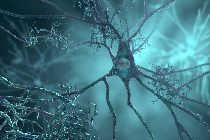 Medicamento para diabetes foi associado a menos amiloide cerebral e decl&iacute;nio cognitivo mais lento na doen&ccedil;a de Alzheimer