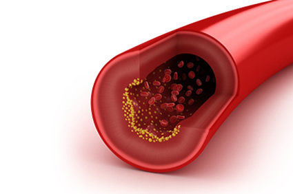 N&iacute;veis muito altos de colesterol HDL foram associados &agrave; morte precoce em pessoas com doen&ccedil;a arterial coronariana