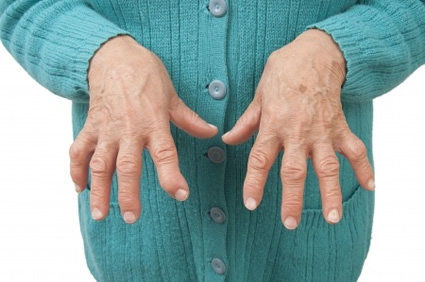 Novo medicamento biológico melhora os sintomas refratários da artrite reumatoide