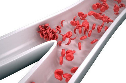 O risco de coágulos sanguíneos cerebrais causados pela COVID-19 é dez vezes maior do que o risco pela vacinação contra a doença