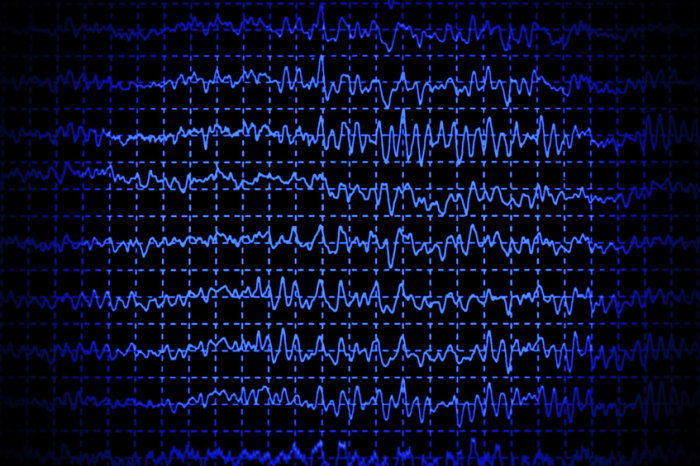 Ondas cerebrais durante o sono preveem o risco de demência