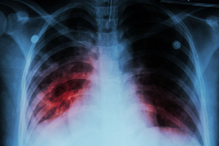Regime de 4 meses de rifapentina com moxifloxacina para tratamento da tuberculose se mostrou não inferior ao regime padrão de 6 meses