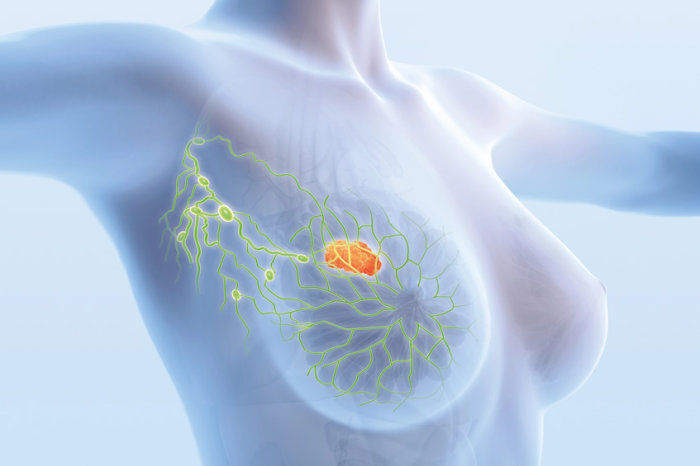 Tipo de c&acirc;ncer de mama dif&iacute;cil de detectar est&aacute; em ascens&atilde;o: taxas de carcinoma lobular invasivo aumentaram quase 3% ao ano de 2012 a 2021