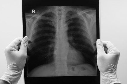 Tuberculose resistente: diagnóstico em dois dias