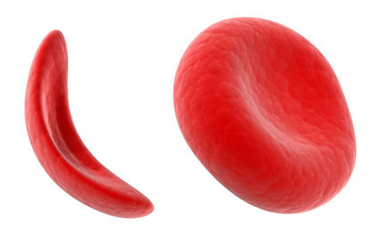 Casgevy: tratamento para doença falciforme criado com edição genética obtém aprovação no Reino Unido