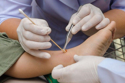 Gel tópico de esmolol ajudou a curar úlceras de pé diabético