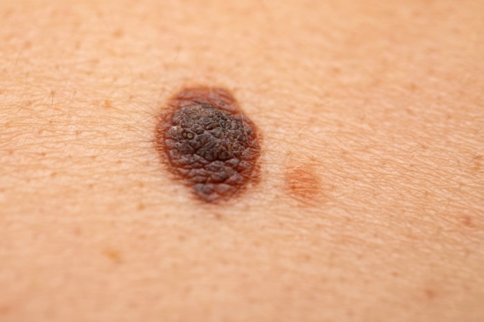 Vacina contra melanoma reduz pela metade o risco de recorrência e metástase em 5 anos