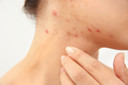 Dermatologistas prop&otilde;em acabar com o monitoramento laboratorial de rotina durante o tratamento com isotretino&iacute;na
